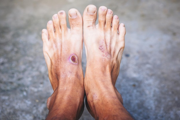 Diabetic Foot Care